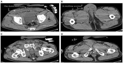 Delayed Diagnosis and Treatment of Traumatic Testicular Dislocation: A Case Report and Literature Review